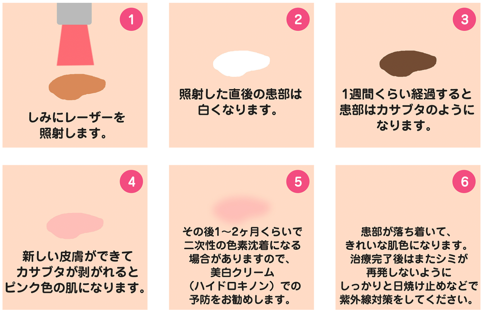 【富山】ピコレーザーによるシミ治療 | 富山の医療脱毛、シミ治療は吉本レディースクリニック美容皮膚科
